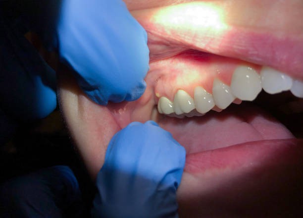 Best Emergency Dentist for Lost Fillings or Crowns in Ruston, LA